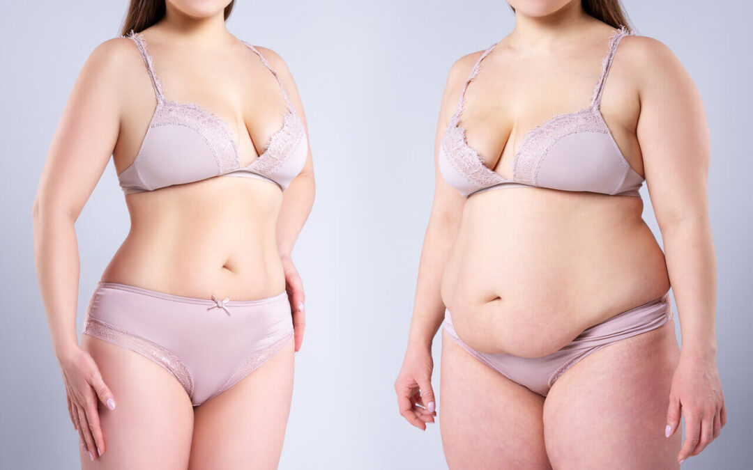 Tummy Tuck Scars After 5 Years: Your Questions Answered