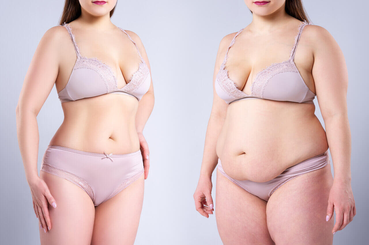 Tummy Tuck Scars After 5 Years: Your Questions Answered